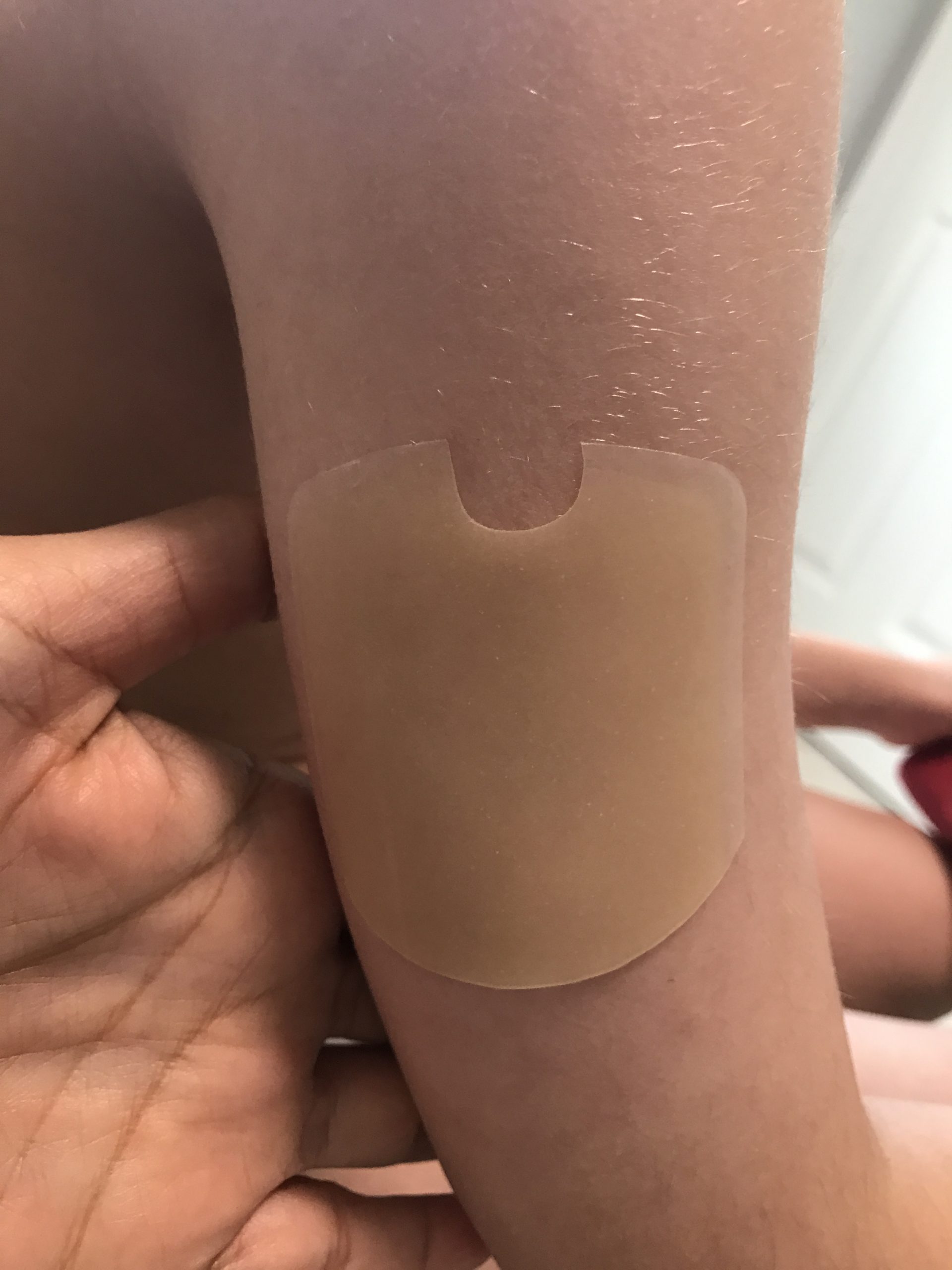 Hydrocolloid Pad “Sandwich Method” For CGM/POD Skin Rash or Irritation