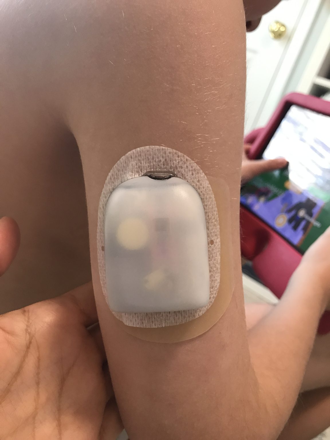 Hydrocolloid Pad “Sandwich Method” For CGM/POD Skin Rash or Irritation